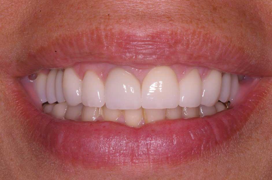 Combination porcelain Crowns and Veneers After
