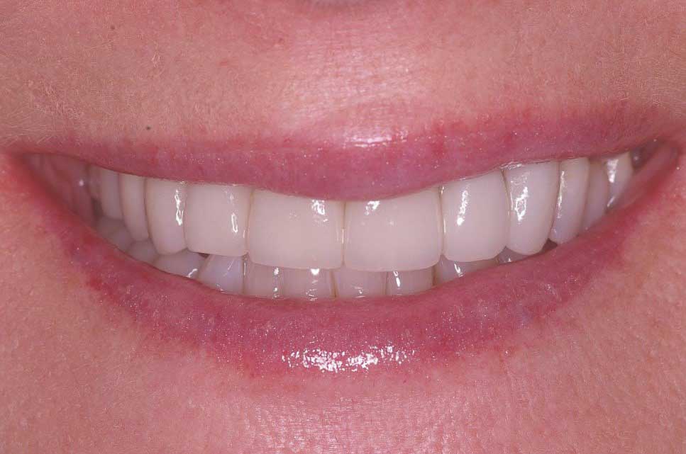 Combination porcelain Crowns and Veneers after