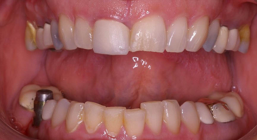 Combination porcelain Crowns and Veneers Before