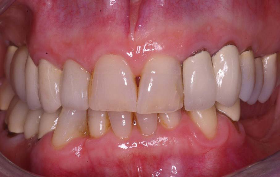 Combination porcelain Crowns and Veneers Before