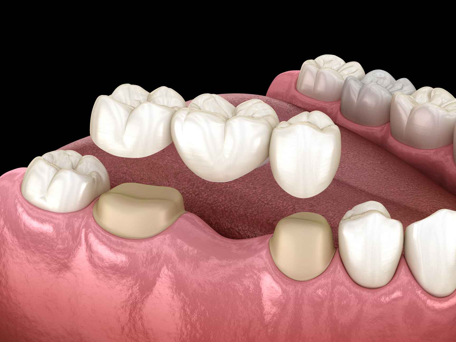 Dental bridge of 3 teeth over molar and premolar