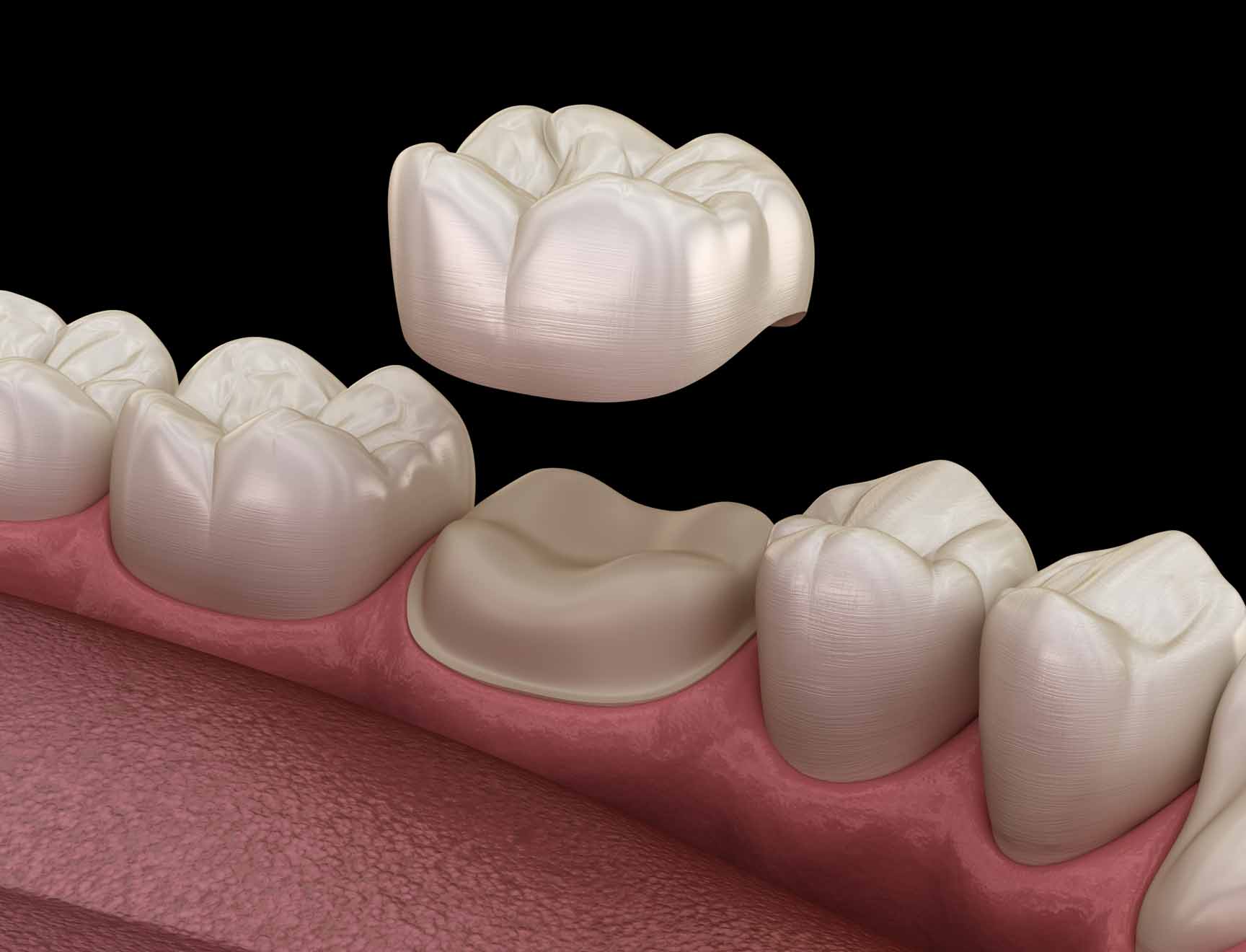 Prepared molar tooth for dental crown placement