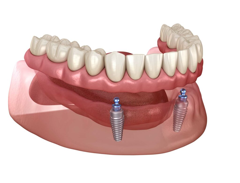 Removable prosthesis All on 2 system supported by implants with ball attachments