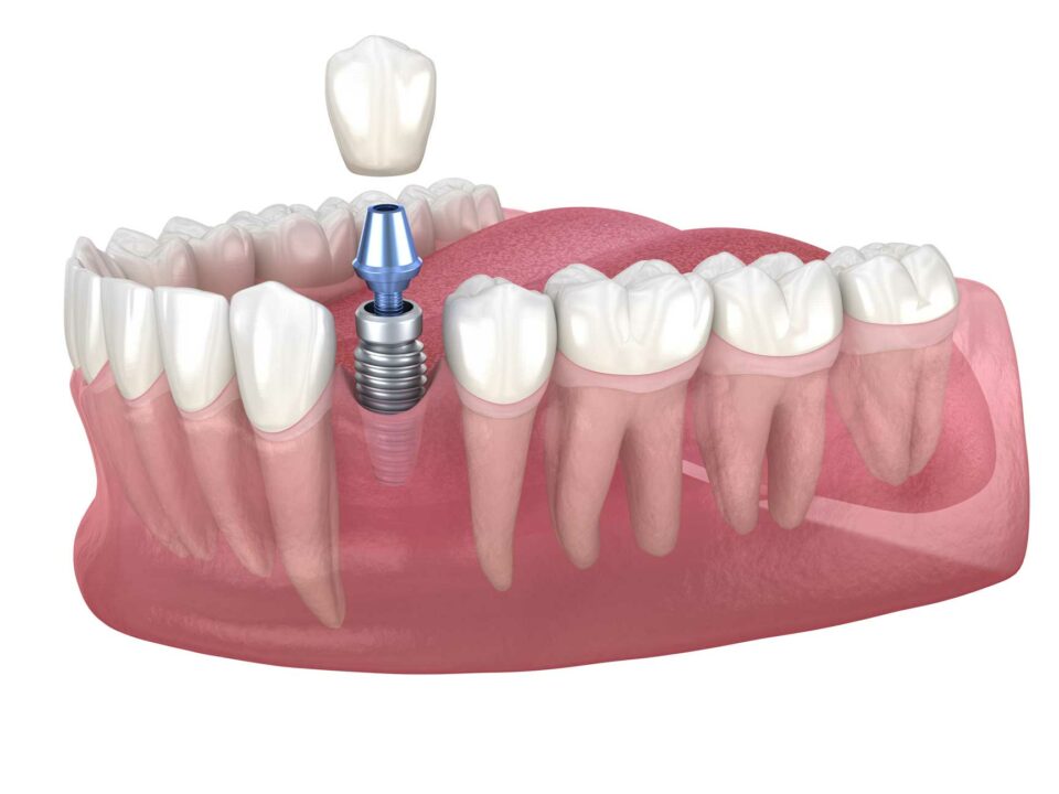 Premolar tooth recovery with implant