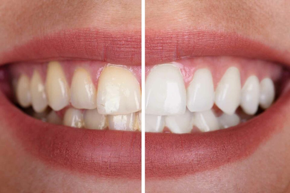 Woman's Teeth Before And After Whitening